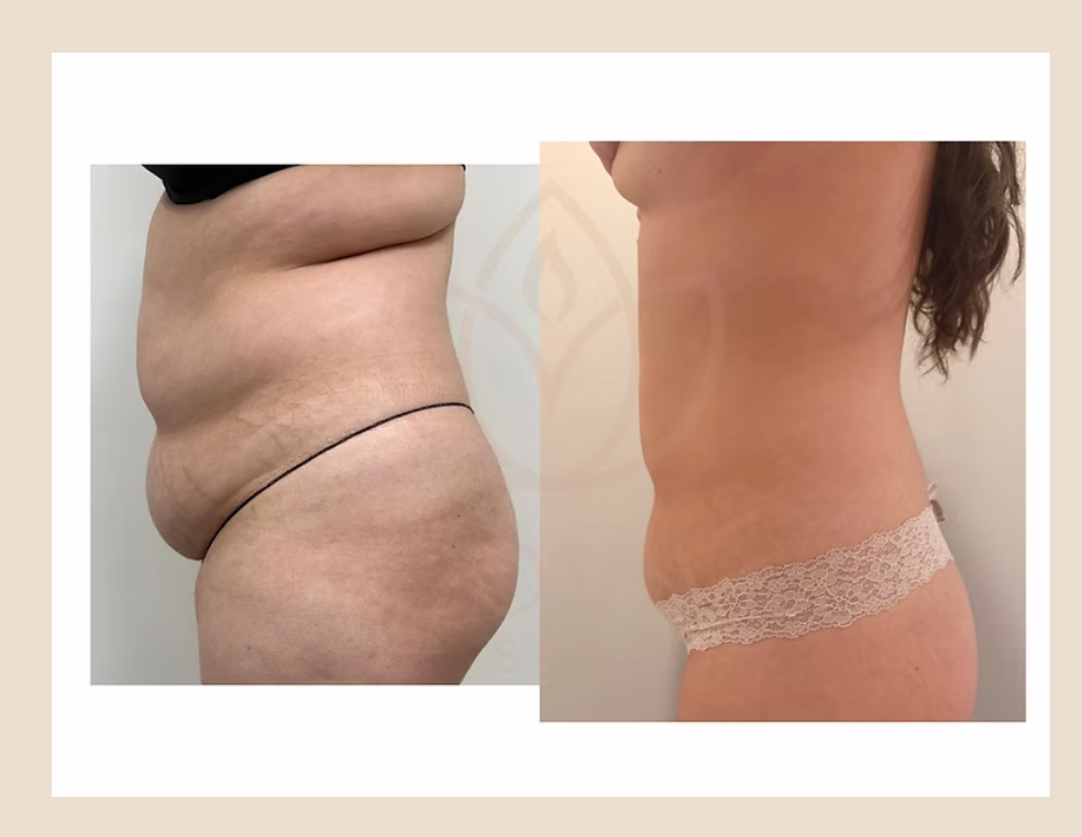 Venus Legacy body contouring results — before and after at Cova Spa